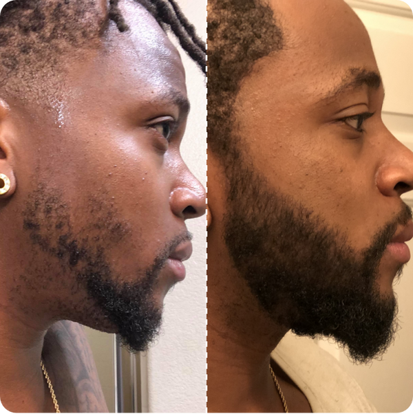 Sérum de crescimento de barba