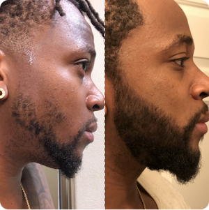Sérum de crescimento de barba